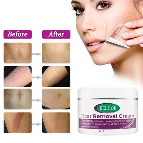 Scar Removal Cream 100 Natural