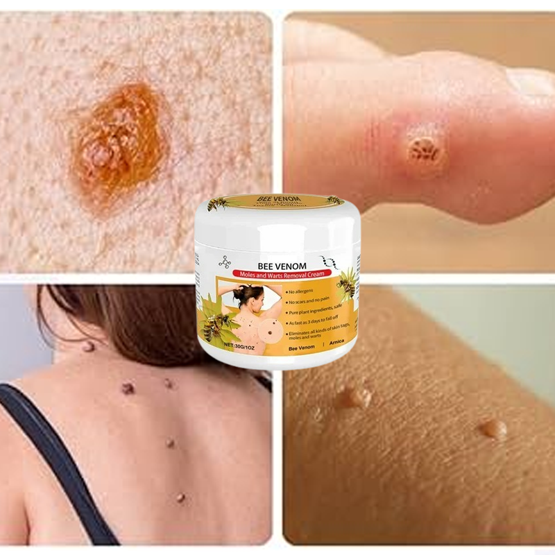Warts Removal Cream 100% Guarantee