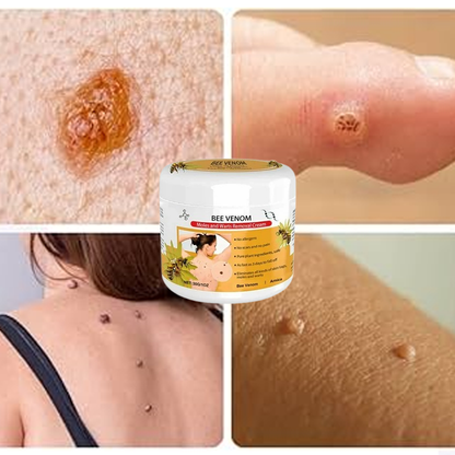 Warts Removal Cream 100% Guarantee