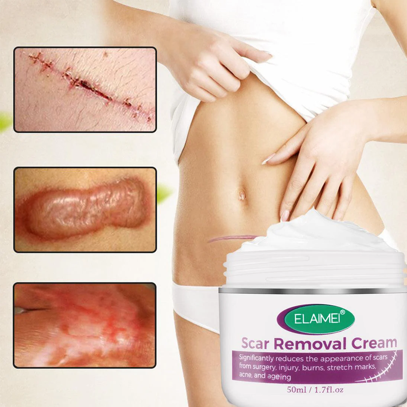 Scar Removal Cream 100% Guarantee
